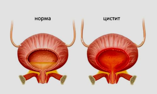 Воспаление слизистого слоя мочевого пузыря - заболевание, возникающее у пациентов любого возраста