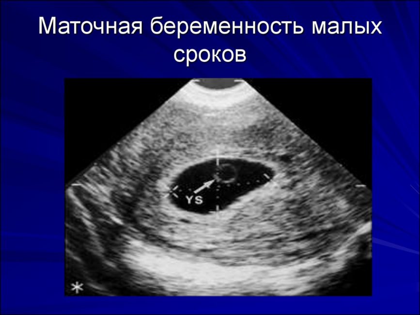 УЗИ на ранних сроках УЗИ на ранних сроках