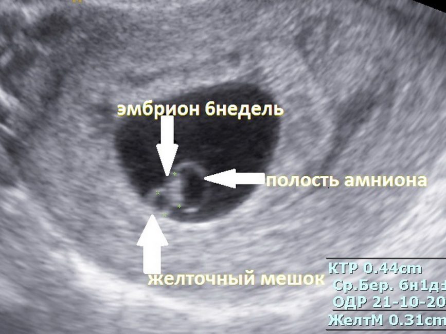 Беременность на УЗИ Беременность на УЗИ