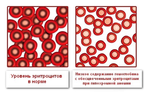 Изменение эритроцитов при снижении цветового показателя Изменение эритроцитов при снижении цветового показателя
