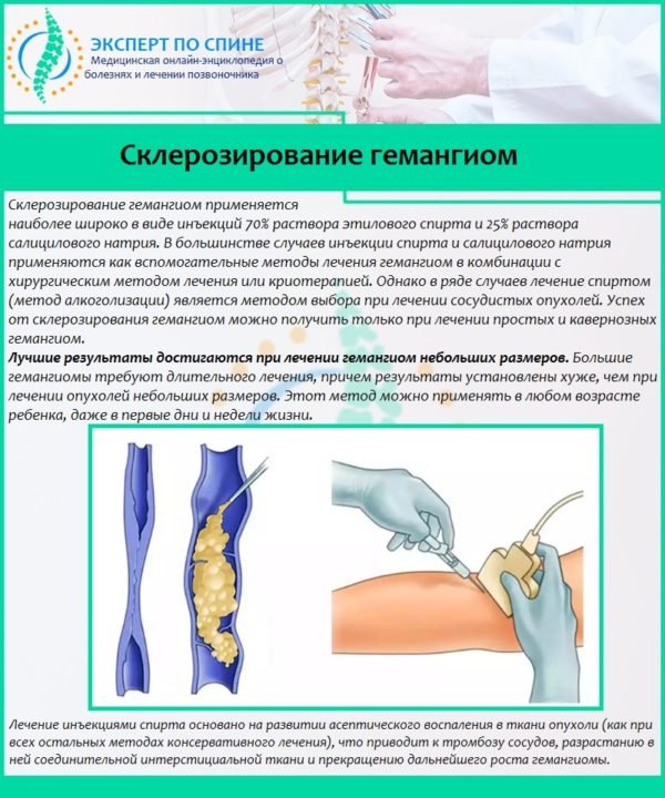 Склерозирование гемангиом