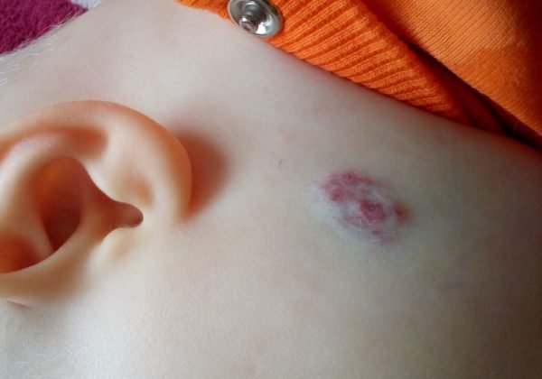 Комбинированная гемангиома после одного сеанса криодеструкции