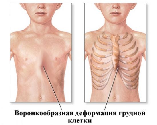 Воронкообразная грудная клетка