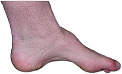 Charcot-marie-tooth foot.jpg