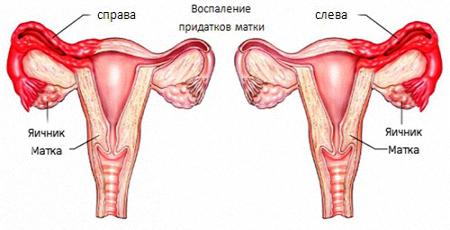Воспаление придатков матки