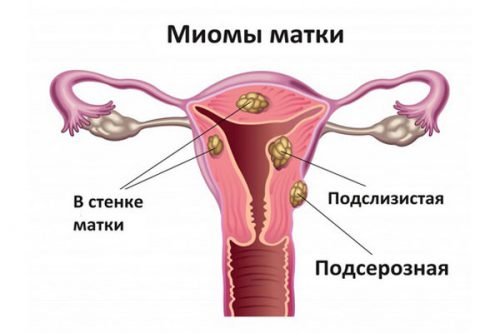 Миома матки