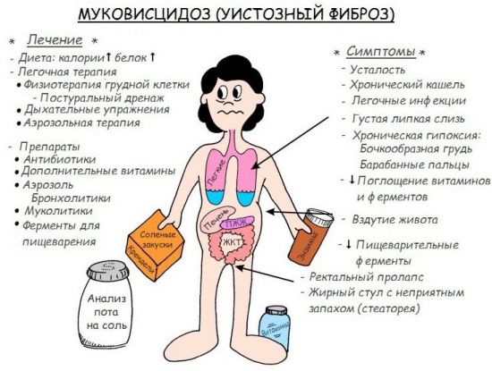 Муковисцидоз