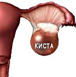 Эндометриоидная киста яичника Эндометриоидная киста яичника