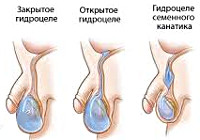 Водянка яичка у мальчика Водянка яичка у мальчика