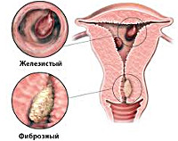 Фиброзный полип эндометрия Фиброзный полип эндометрия