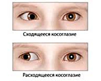 Содружественное косоглазие Содружественное косоглазие