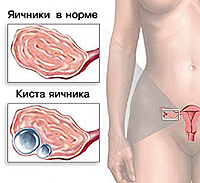 Киста яичника Киста яичника