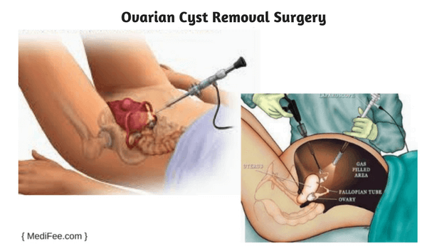 what is ovarian cyst removal surgery
