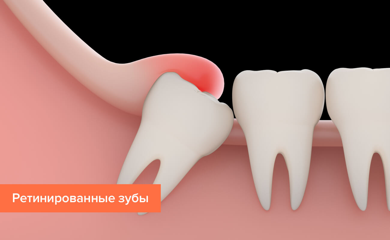 Ретинированные зубы в картинках Ретинированные зубы в картинках