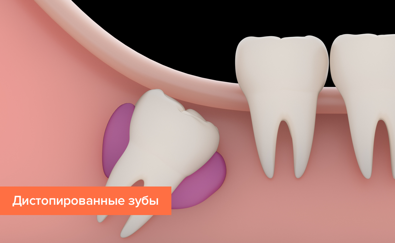 Дистопированные зубы в картинках Дистопированные зубы в картинках
