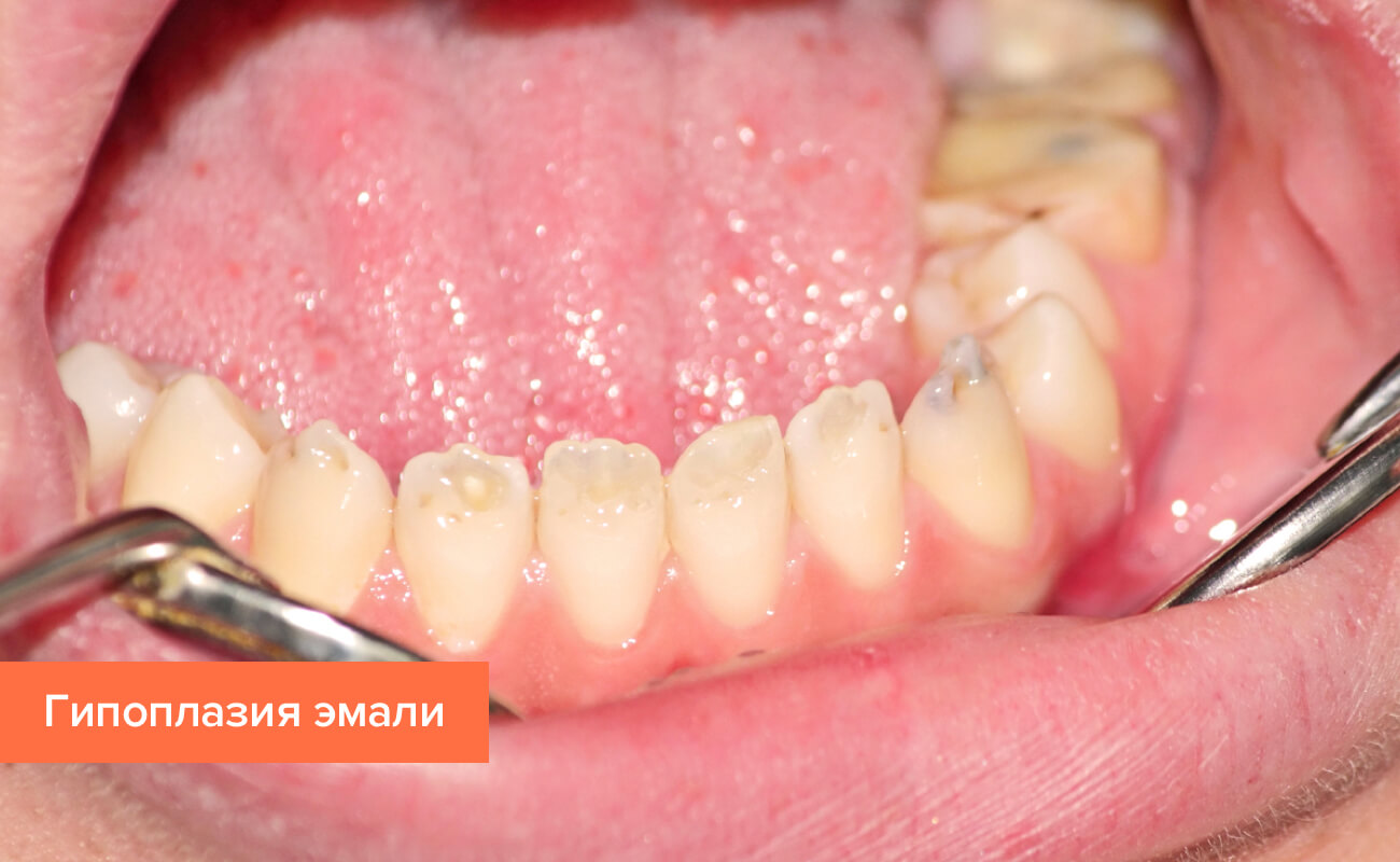 Гипоплазия эмали зубов Фото гипоплазии эмали зубов