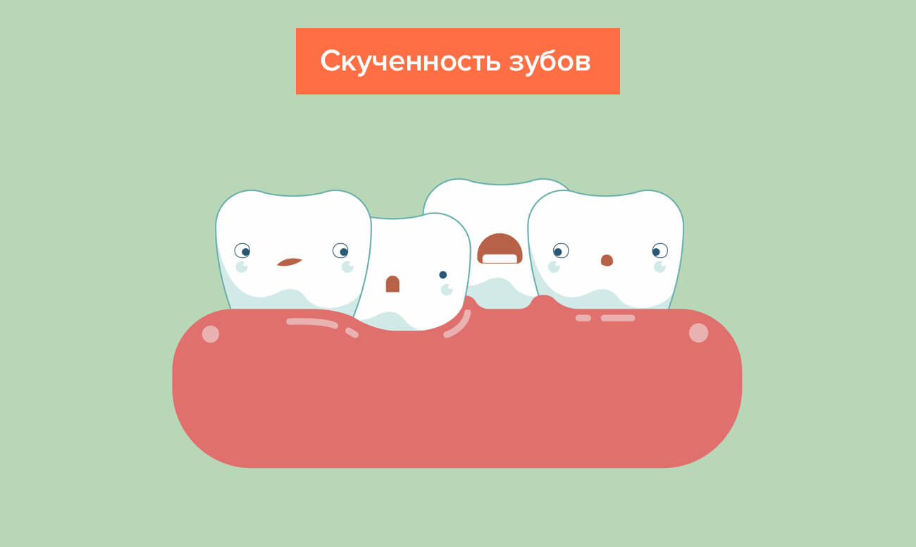 Скученность зубов в картинках Скученность зубов в картинках