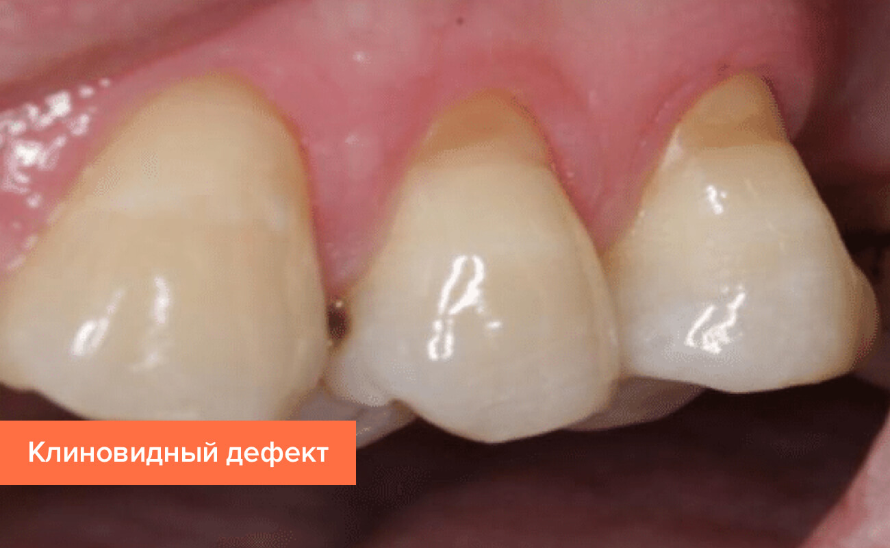 Клиновидный дефект на зубах Фото клиновидного дефекта на зубах