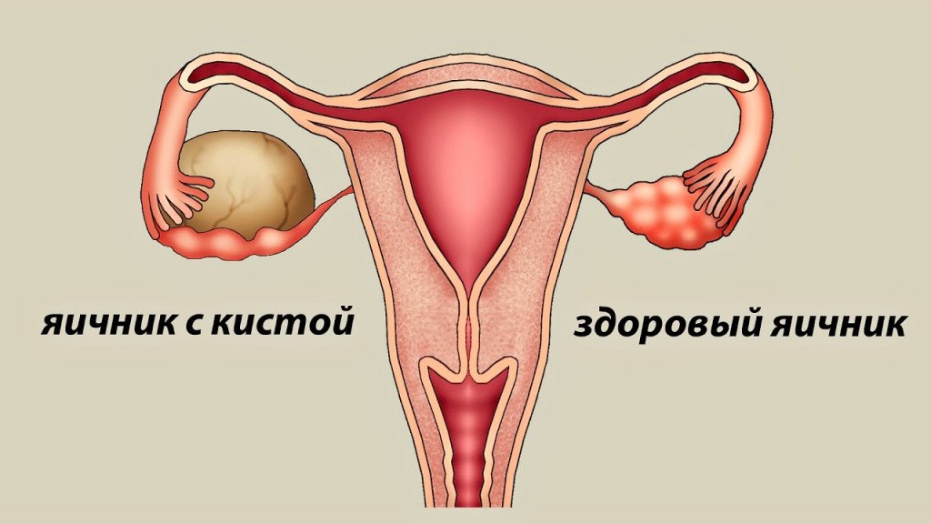 Кисты яичников: классификация, клиника, диагностика и лечение Кисты яичников: классификация, клиника, диагностика и лечение